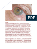 Chronic Anterior Uveitis