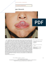 Tongue Mucocele: Images in Clinical Medicine