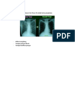 Gambaran Foto Thorax TB Setelah Tuntas Pengobatan