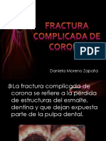 Fractura Corona