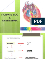 Normal Ecg & Arrhythmia