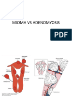 Mioma Vs Adenomyosis