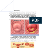 Ca Cervix