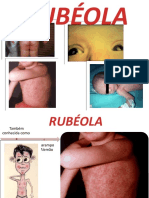 Rubeola Apresentaçao