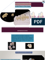 Incrustaciones, Operatoria dental.pptx