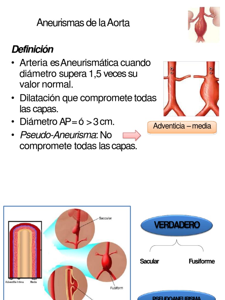 Clasificación y manejo de aneurismas aórticos | PDF | Angiografía ...