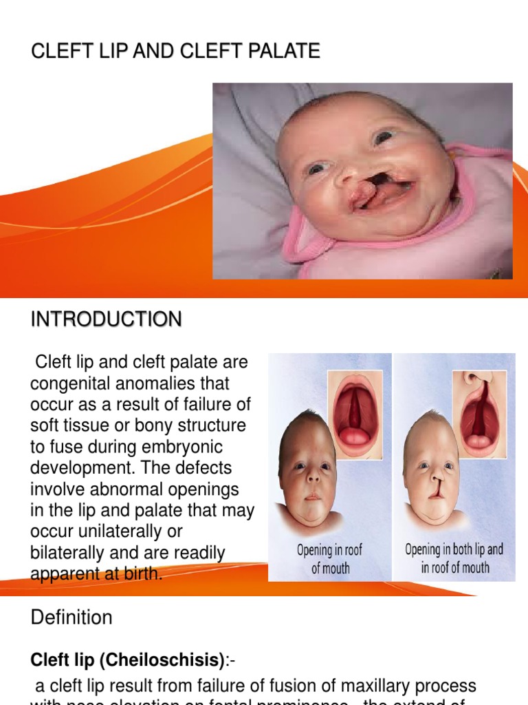 Cleft Lip and Cleft Palate | Download Free PDF | Medicine | Health Sciences