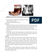 Gambar 9.2: Gigi Supernumerary Mesioden Yang Erupsi Di Palatal Dengan Gambaran Radiografi