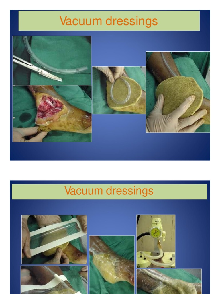 Vacuum dressings for open fractures PDF