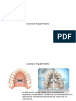 Expansión Rápida Palatina