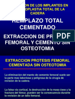 Extraccion de Protesis Femoral Cementada Sin Osteotomia