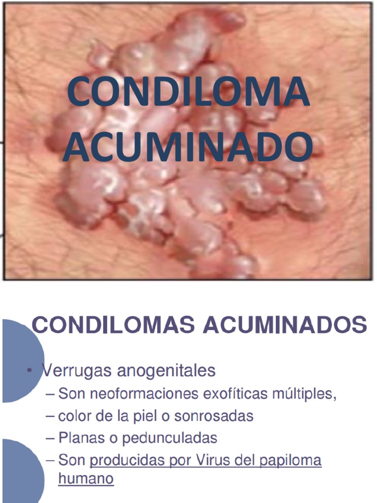 Tipos y Tratamiento del Condiloma Acuminado | PDF | Ciencia y matemáticas