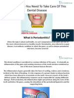 Periodontitis You Need To Take Care