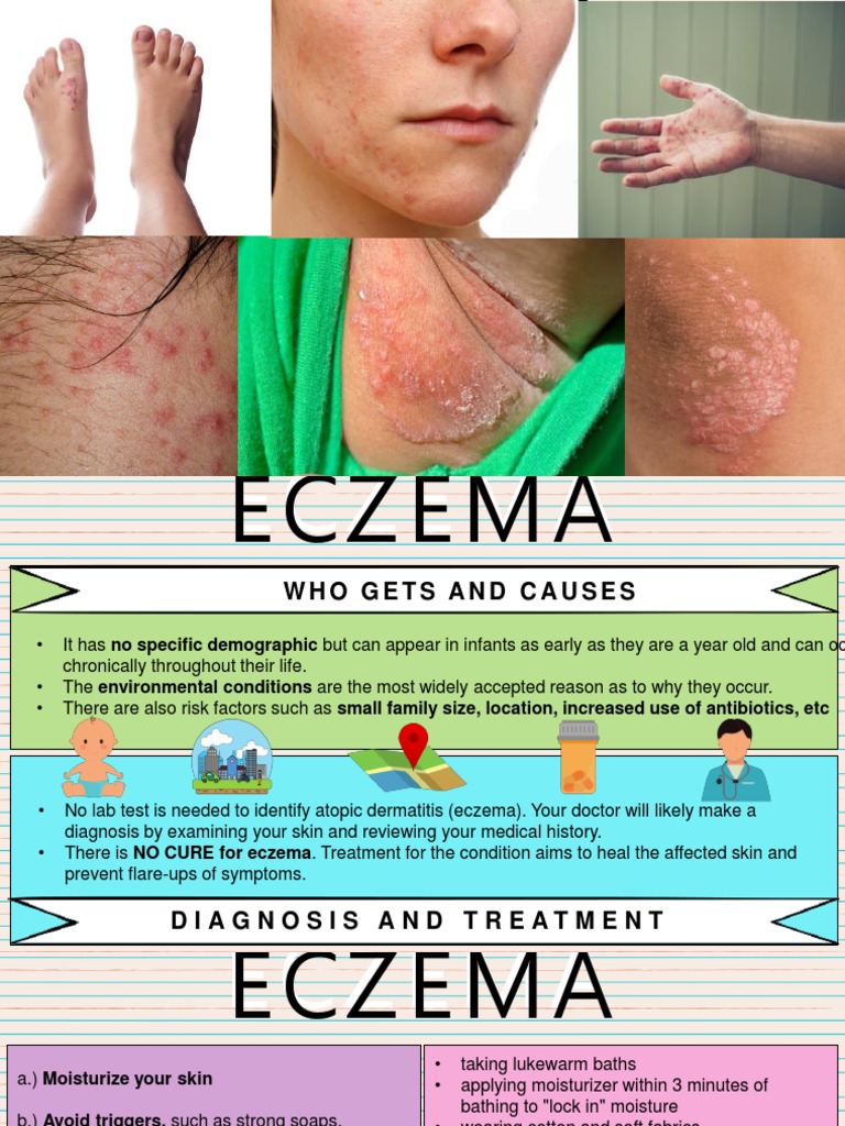 Understanding Eczema Causes, Symptoms, Diagnosis and Treatment Options