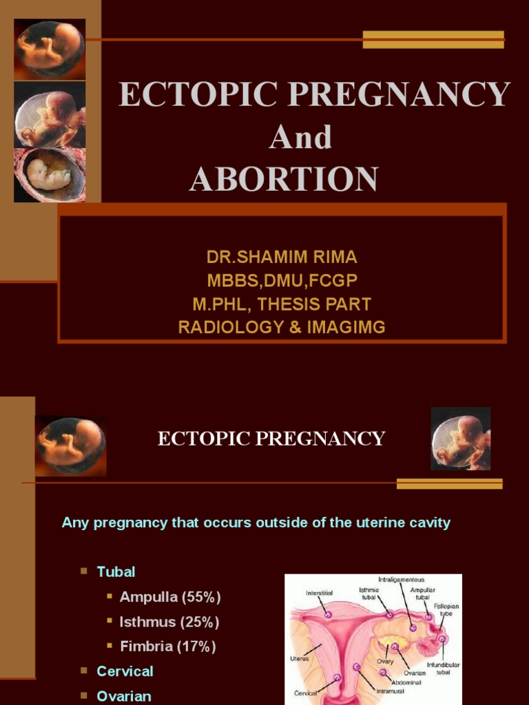 Ectopic Pregnancy Miscarriage Uterus