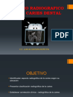 Estudio radiográfico de la caries dental