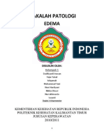 Edema