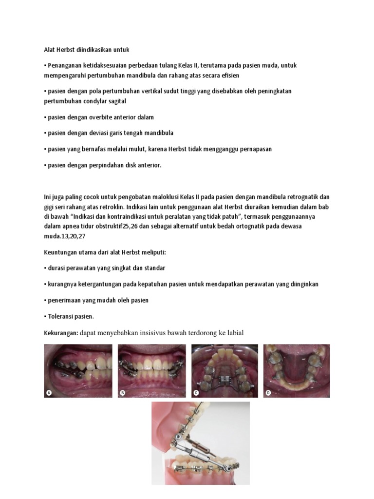 Herbst Appliance PDF