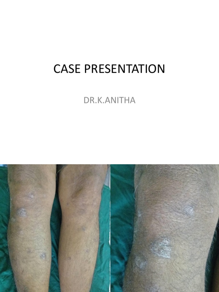Psoriasis Case Presentation - pptx2 | PDF