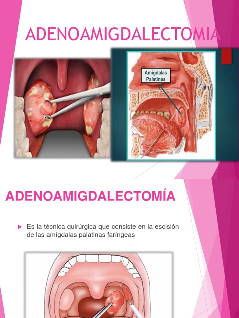 ADENOAMIGDALECTOMIA | PDF | Anatomía humana | Medicina