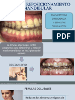 Placa de Reposicionamiento Mandibular