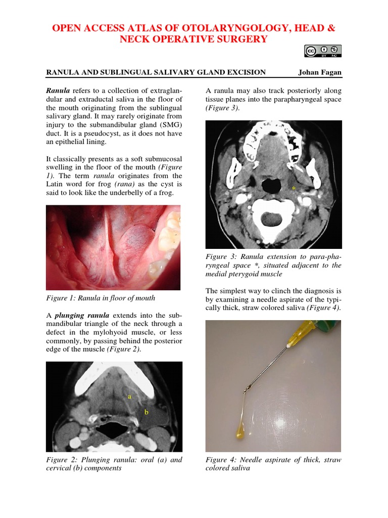Ranula and Sublingual Salivary Gland Excision PDF | PDF | Tongue | Glands