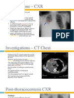 Investigations - CXR: PA Film, Adequate Inspiration and Penetration Findings