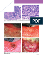 Histopathology of Basal Cell Carcinoma PDF