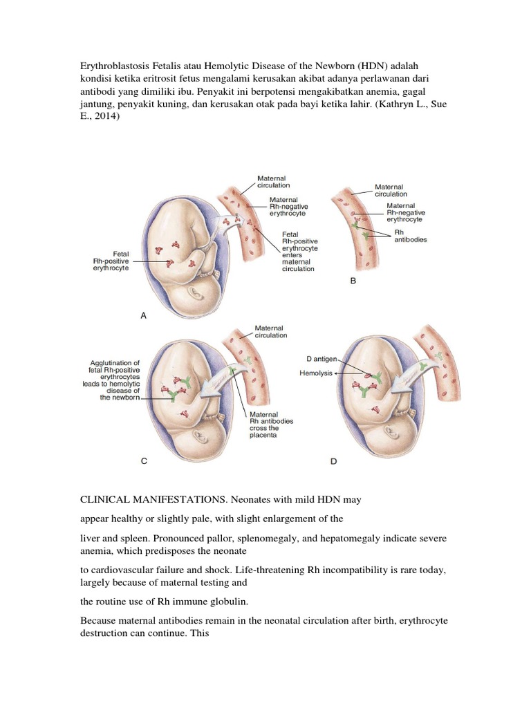 HDN Alias Eritroblastosis Fetalis | PDF | Serology | Clinical Pathology