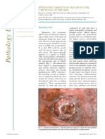 squamous carcinoma.pdf