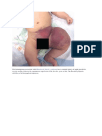 The Hemangiomas Associated With