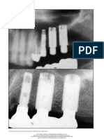 Platform Switching A New Concept in Implant Dentistry For Controlling Postrestorative Crestal Bone Levels PDF