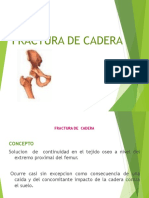 Fractura de Cadera