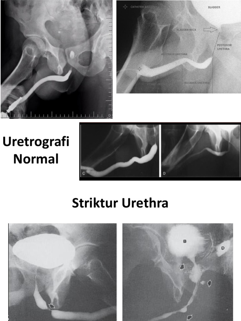 Uretrografi | PDF