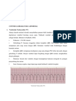 Contoh Gambaran Ekg Abnormal