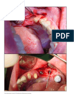 Periosteal Pocket Flap For Horizontal Bone Regener