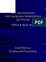 ACL Reconstruction With Autogenous Semitendonosis and Gracilis - Beach