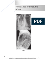 chest radio 5 pleural thickening and pleural calcification