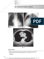 chest radio 9 anterior mediastinal mass