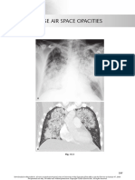 chest radio 15 diffuse air space opacities