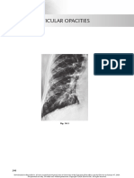 chest radio 18 fine reticular opacities