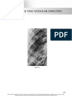 chest radio 17 diffuse fine nodular opacities.pdf