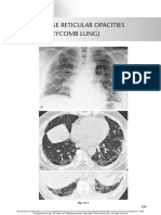 chest radio 19 coarse reticular opacities.pdf