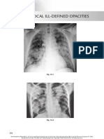 Chest Radio 16 Multifocal Ill Defined Opacities PDF