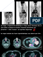 Granulomatose Avec Polynagéite Final