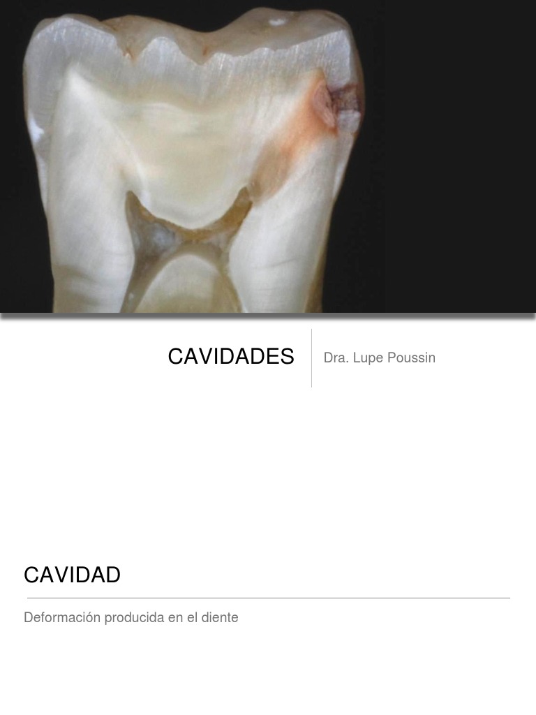 Cavidades Dentales | PDF | Rtt | Odontología