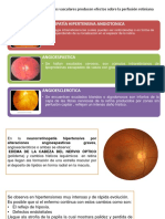 Cambios retinianos en retinopatía hipertensiva