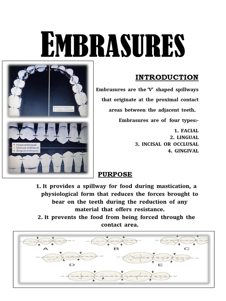 Types of Embrasures in Dentistry | PDF
