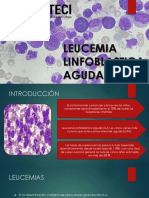 Leucemia Linfoblastica Aguda