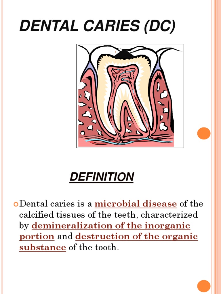 Dental Caries | PDF | Tooth Enamel | Dentin